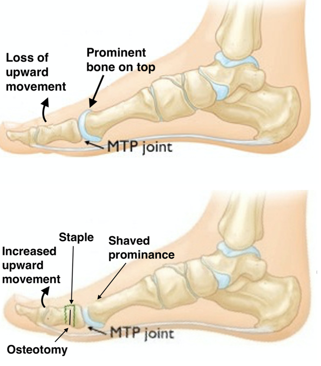 Hallux Rigidus - Foot Centre